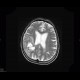 Oligodendroglioma of parietal lobe: MRI - Magnetic Resonance Imaging